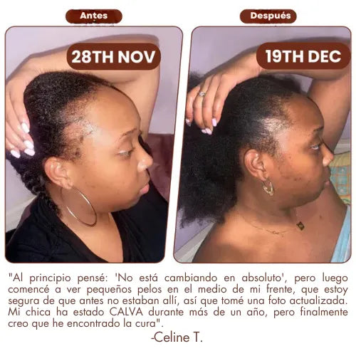 Aceite de biotina para el crecimiento del cabello