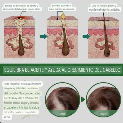 Aceite de Romero | ¡Despídete de la caída del cabello!