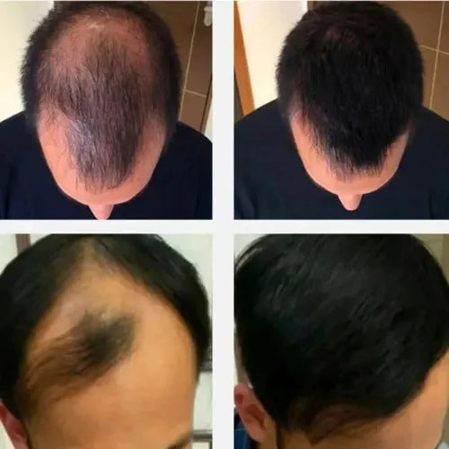 Aceite de Romero | ¡Despídete de la caída del cabello!