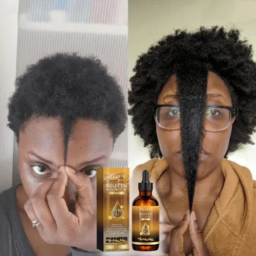 Aceite de biotina para el crecimiento del cabello